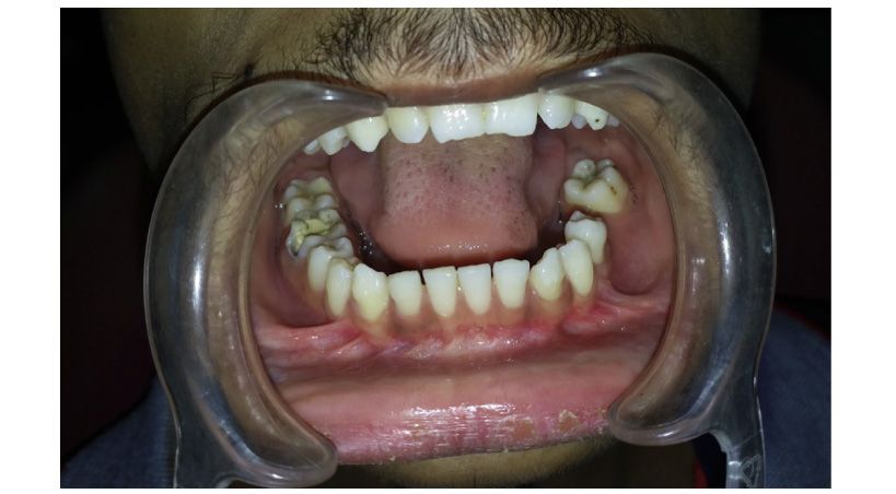 Papel del médico oral en el diagnóstico de hiperparatiroidismo