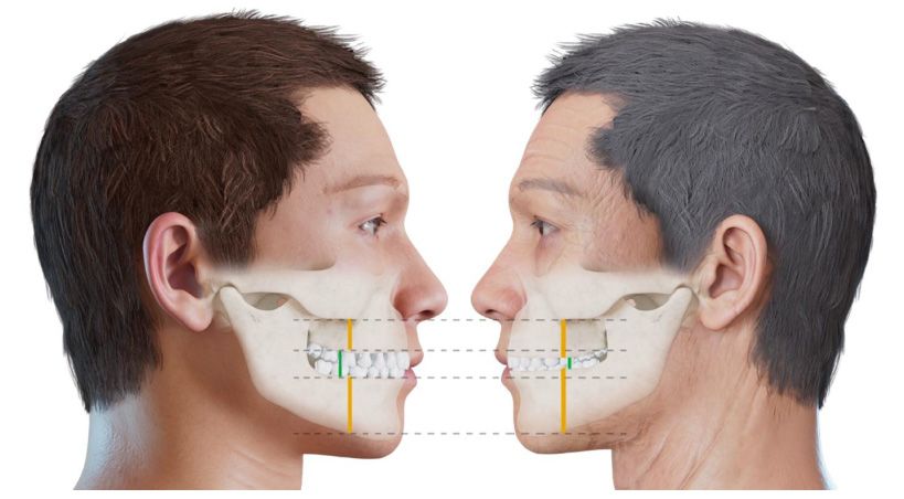 Importancia de una Fase de Evaluación al Aumentar la Dimensión Vertical Oclusal