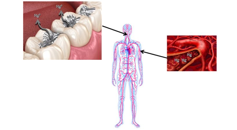 Amalgamas dentales y concentraciones de mercurio en sangre en adultos estadounidenses.