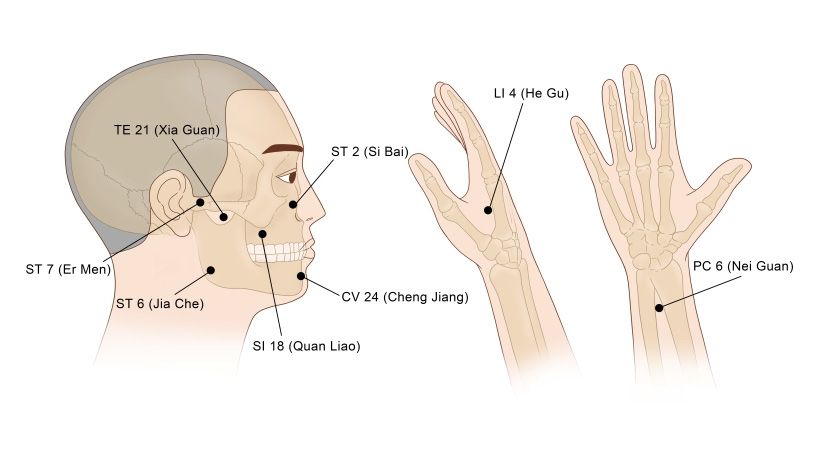 Aplicación de la acupuntura en el manejo del dolor orofacial neuropático