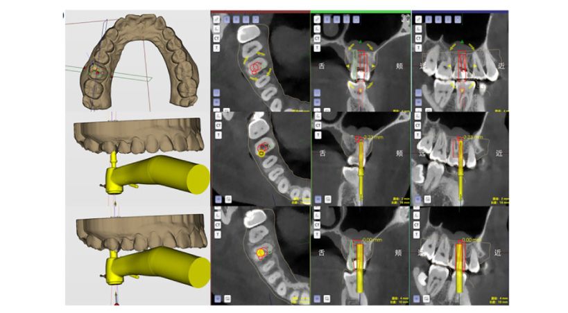 Autotrasplante de terceros molares en el maxilar asistido por robot: dos reportes de caso